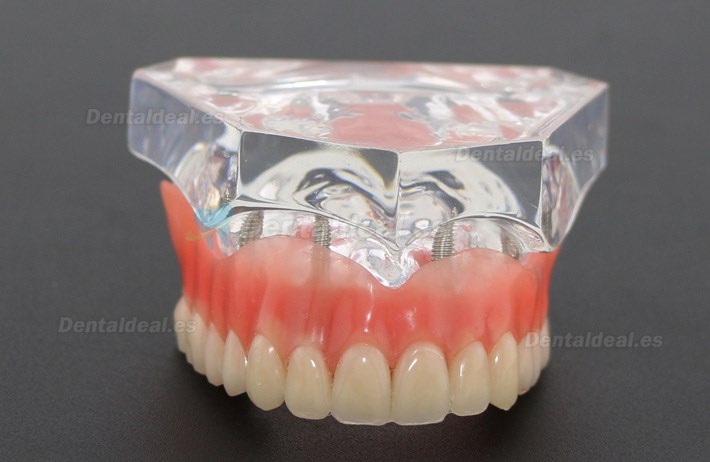 Dental Study Teeth Model Overdenture Superior With 4 Implants Demo Model 6001